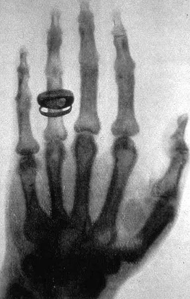 تصویر دست همسر رونتگن در سال ۱۸۹۶ یکی از اولین تصاویر عکاسی شده به وسیله پرتو ایکس